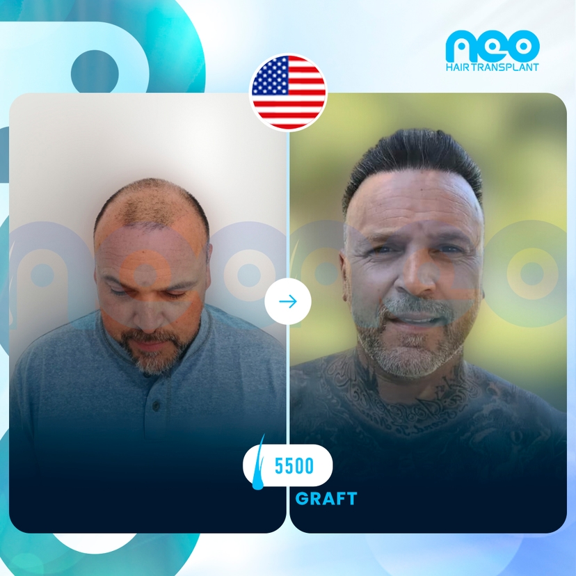 Neo Hair Before After 1