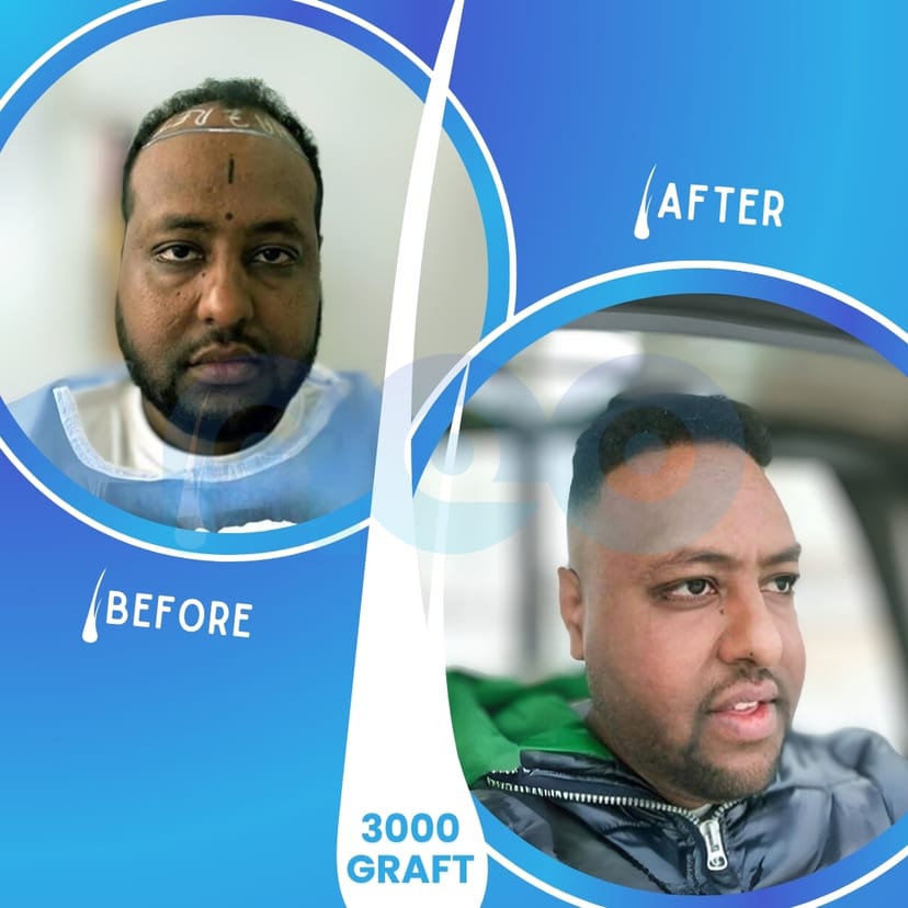 Neo Hair Before After 3