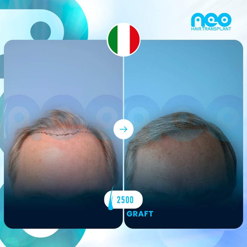 Neo Hair Before After 2
