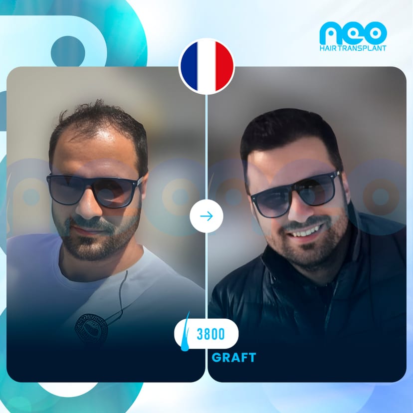 Neo Hair Before After 1