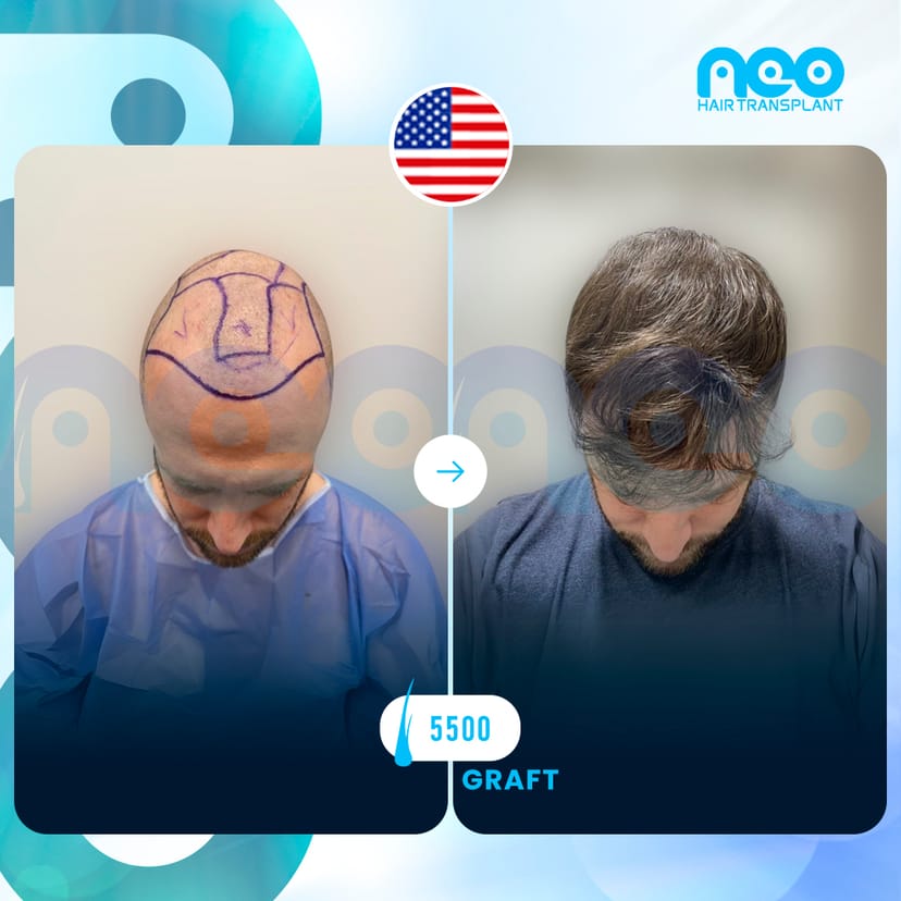 Neo Hair Before After 0