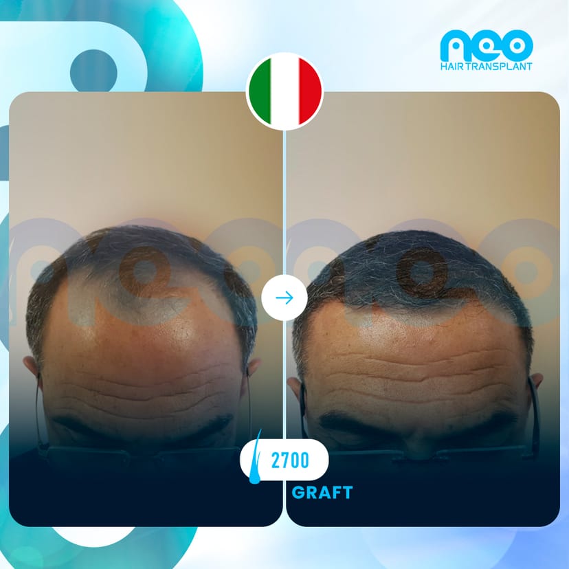 Neo Hair Before After 12