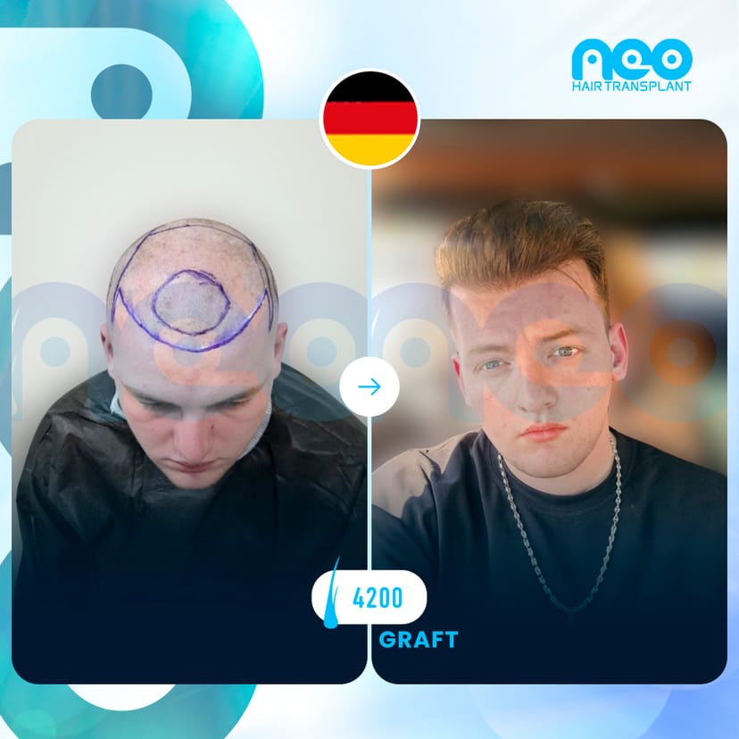 Neo Hair Before After 14