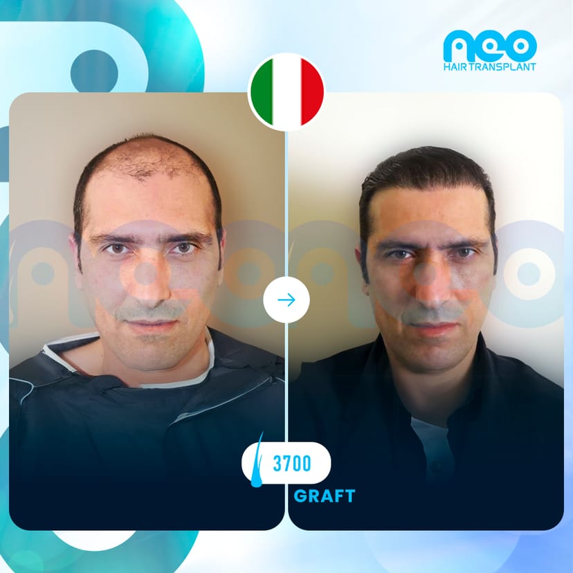Neo Hair Before After 15
