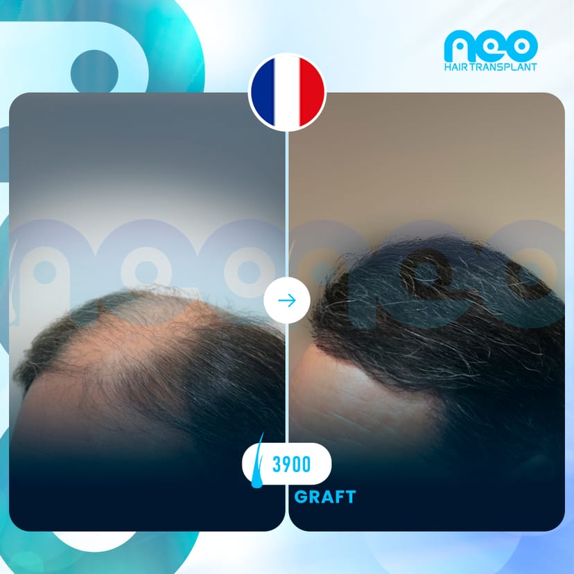 Neo Hair Before After 3