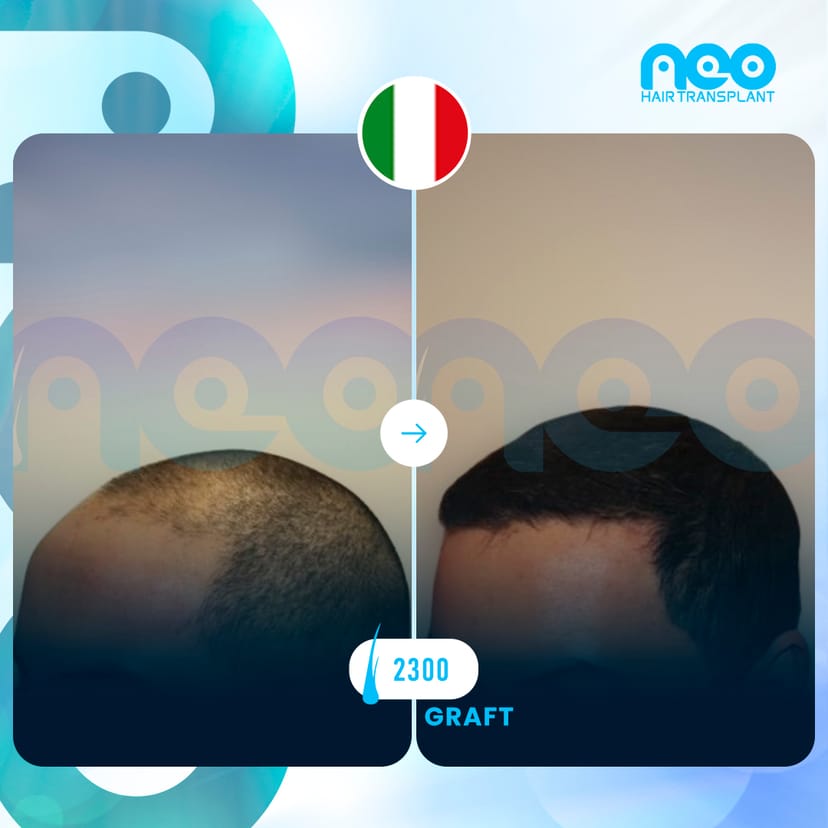 Neo Hair Before After 4