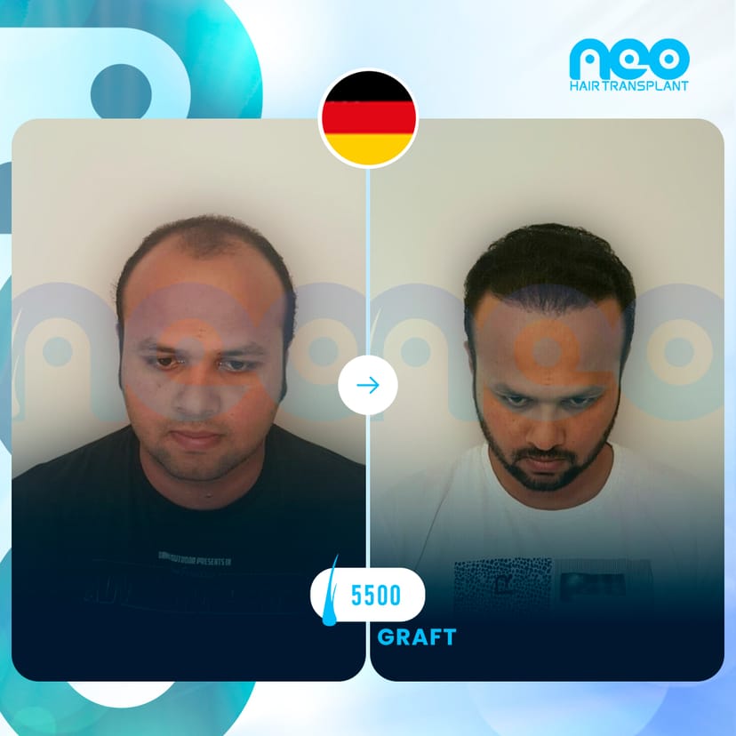 Neo Hair Before After 5