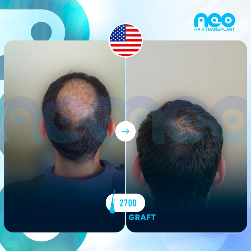 Neo Hair Before After 6