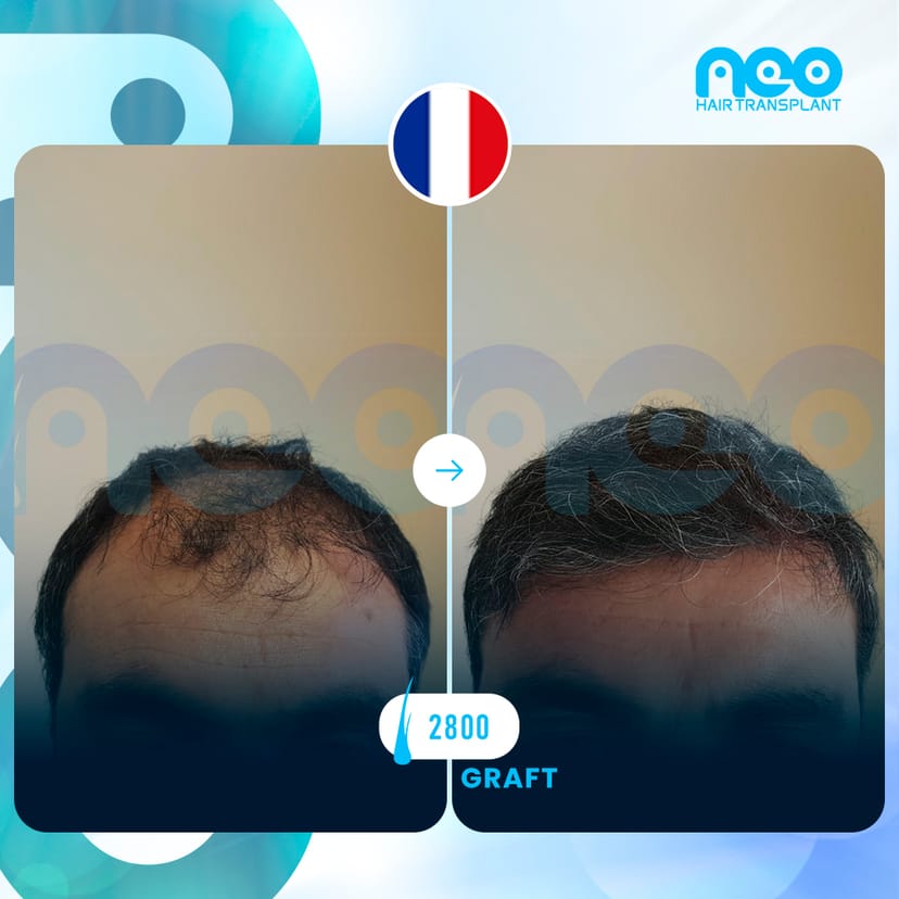 Neo Hair Before After 7