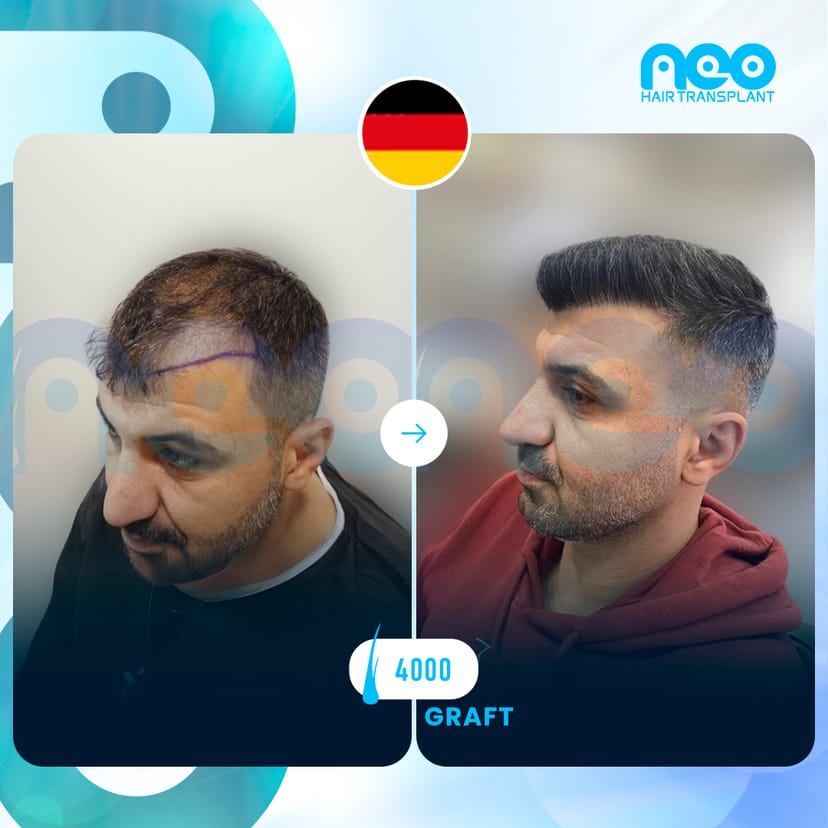 Neo Hair Before After 8