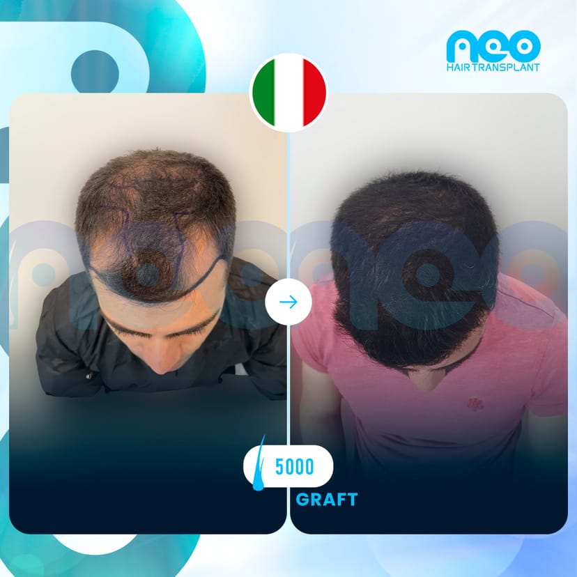 Neo Hair Before After 9